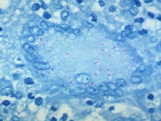 Cutaneous Tuberculosis