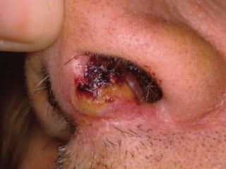 Cutaneous Tuberculosis