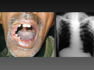 Cutaneous Tuberculosis