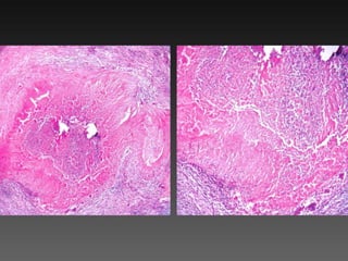 Cutaneous Tuberculosis