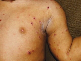 Cutaneous Tuberculosis