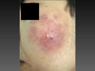 Cutaneous Tuberculosis