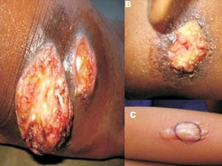 Cutaneous Tuberculosis
