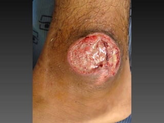 Cutaneous Tuberculosis