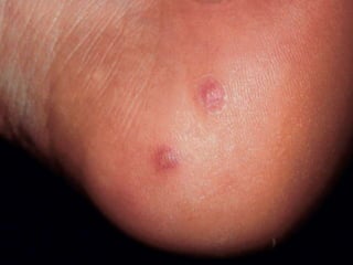 Cutaneous Tuberculosis