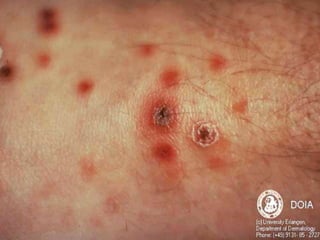 Cutaneous Tuberculosis