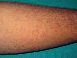 Cutaneous Tuberculosis