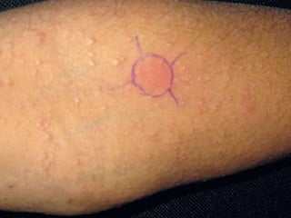 Cutaneous Tuberculosis