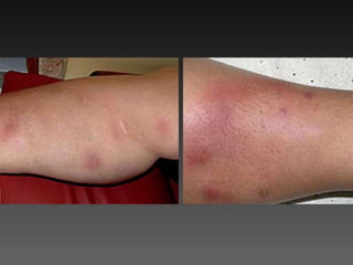 Cutaneous Tuberculosis