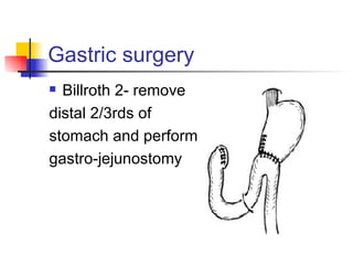 Gastric surgery Billroth 2- remove  distal 2/3rds of  stomach and perform gastro-jejunostomy 