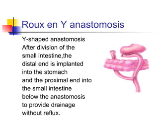 Roux en Y anastomosis Y-shaped anastomosis After division of the small intestine,the distal end is implanted into the stomach  and the proximal end into the small intestine below the anastomosis to provide drainage without reflux. 