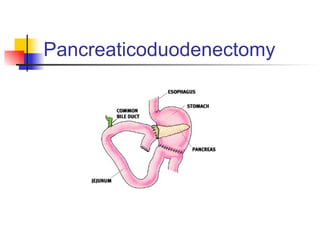 Pancreaticoduodenectomy 