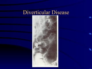 Diverticular Disease 