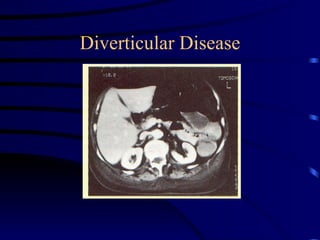 Diverticular Disease