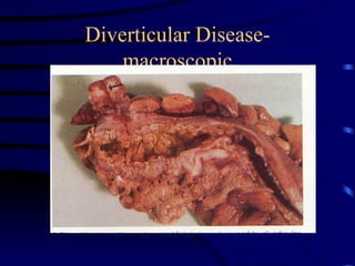 Diverticular Disease-macroscopic 