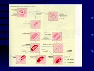 Diverticular Disease 