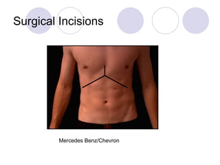 Surgical Incisions Mercedes Benz/Chevron 
