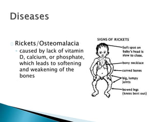Rickets/Osteomalacia 
◦ caused by lack of vitamin 
D, calcium, or phosphate, 
which leads to softening 
and weakening of the 
bones 
 