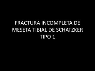 FRACTURA INCOMPLETA DE
MESETA TIBIAL DE SCHATZKER
TIPO 1
 