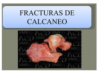 FRACTURAS DE
CALCANEO
 