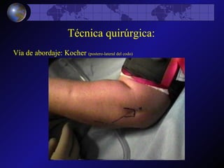 Técnica quirúrgica: Vía de abordaje: Kocher  (postero-lateral del codo) 