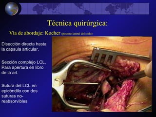 Disección directa hasta la capsula articular. Sección complejo LCL, Para apertura en libro de la art. Sutura del LCL en epicóndilo con dos suturas no-reabsorvibles Técnica quirúrgica: Vía de abordaje: Kocher  (postero-lateral del codo) 