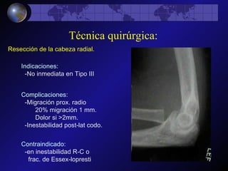 Resección de la cabeza radial. Contraindicado: -en inestabilidad R-C o  frac. de Essex-lopresti Complicaciones: -Migración prox. radio 20% migración 1 mm. Dolor si >2mm. -Inestabilidad post-lat codo. Indicaciones: -No inmediata en Tipo III Técnica quirúrgica: 