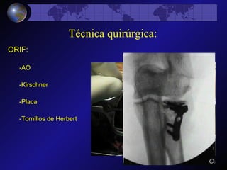 ORIF: Técnica quirúrgica: -AO -Placa -Tornillos de Herbert -Kirschner 