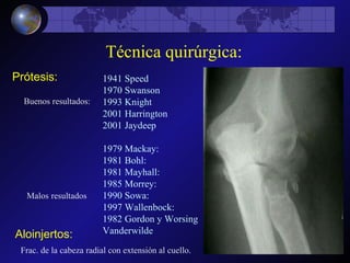 Técnica quirúrgica: Prótesis: Aloinjertos: Frac. de la cabeza radial con extensión al cuello. Buenos resultados: 1941 Speed 1ª Prótesis de metal. 1970 Swanson 1ª Prótesis de silicona.   1993 Knight Estudio en cadáver, metal. 2001 Harrington   80% éxitos. 2001 Jaydeep  70% éxitos. Malos   resultados 1979 Mackay: 20% migración. Próx. 1981 Bohl: 1981 Mayhall: 1985 Morrey: 50% fallos. Uso muy limitado. 1990 Sowa: 1997 Wallenbock: Mejores resultados en resección. 1982 Gordon y Worsing   Sinovitis con silicona. Vanderwilde Espaciador temporal. Sinovitis. 