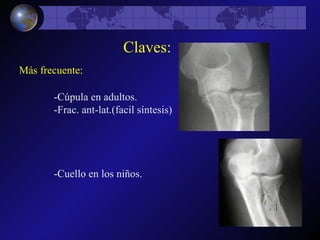-Cúpula en adultos. -Frac. ant-lat.(facil síntesis) -Cuello en los niños. Claves: Más frecuente: 