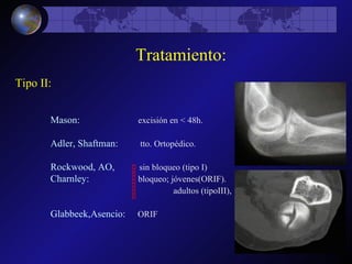 Mason :      excisión en < 48h. Adler, Shaftman :  tto. Ortopédico. Rockwood, AO ,  sin bloqueo (tipo I) Charnley:   bloqueo; jóvenes(ORIF).     adultos (tipoIII),   Glabbeek,Asencio :  ORIF Tratamiento: Tipo II: 