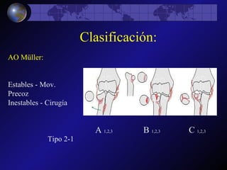 Clasificación: AO Müller: Estables - Mov. Precoz Inestables - Cirugía Tipo 2-1 A  1,2,3  B  1,2,3   C  1,2,3 