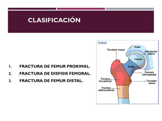 Femula Fx femur-1-2 | PPT