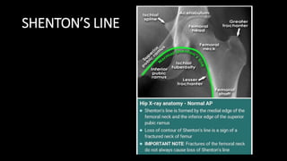 Fx neck-of-femur | PPTX