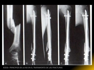 RÜEDI- PRINCIPIOS DE LA AO EN EL TRATAMIENTO DE LAS FRACTURAS
 