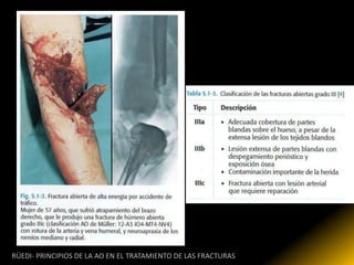 RÜEDI- PRINCIPIOS DE LA AO EN EL TRATAMIENTO DE LAS FRACTURAS
 