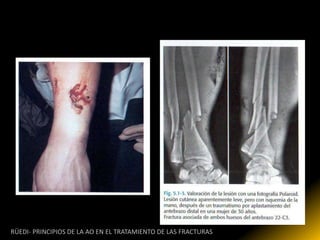 RÜEDI- PRINCIPIOS DE LA AO EN EL TRATAMIENTO DE LAS FRACTURAS
 
