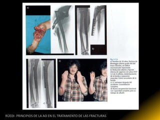 RÜEDI- PRINCIPIOS DE LA AO EN EL TRATAMIENTO DE LAS FRACTURAS
 