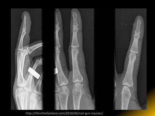 http://lifeinthefastlane.com/2010/06/nail-gun-injuries/
 