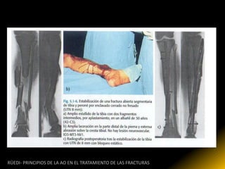 RÜEDI- PRINCIPIOS DE LA AO EN EL TRATAMIENTO DE LAS FRACTURAS
 