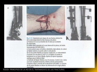 RÜEDI- PRINCIPIOS DE LA AO EN EL TRATAMIENTO DE LAS FRACTURAS
 