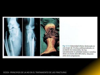 RÜEDI- PRINCIPIOS DE LA AO EN EL TRATAMIENTO DE LAS FRACTURAS
 