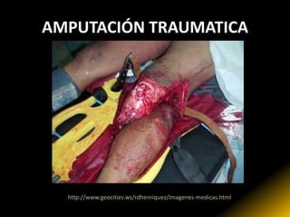 AMPUTACIÓN TRAUMATICA




  http://www.geocities.ws/rdhenriquez/Imagenes-medicas.html
 