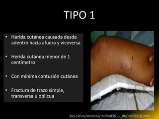 TIPO 1
• Herida cutánea causada desde
  adentro hacia afuera y viceversa

• Herida cutánea menor de 1
  centímetro

• Con mínima contusión cutánea

• Fractura de trazo simple,
  transversa u oblicua


                        http://bvs.sld.cu/revistas/mil/vol35_1_06/mil08106.htm
 