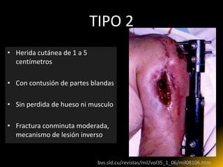 TIPO 2
• Herida cutánea de 1 a 5
  centímetros

• Con contusión de partes blandas

• Sin perdida de hueso ni musculo

• Fractura conminuta moderada,
  mecanismo de lesión inverso


                       http://bvs.sld.cu/revistas/mil/vol35_1_06/mil08106.htm
 