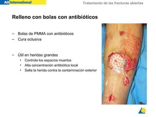 Tratamiento de las fracturas abiertas



Relleno con bolas con antibióticos


– Bolas de PMMA con antibióticos
– Cura oclusiva



– Útil en heridas grandes
    •   Controla los espacios muertos
    •   Alta concentración antibiótica local
    •   Sella la herida contra la contaminación exterior
 