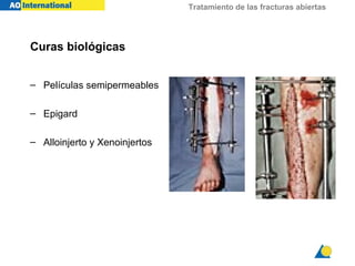 Tratamiento de las fracturas abiertas




Curas biológicas


– Películas semipermeables

– Epigard

– Alloinjerto y Xenoinjertos
 