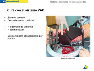 Tratamiento de las fracturas abiertas
– Sistema cerrado
– Desbridamiento contínuo
– < el tamaño de la herida
– < edema tisular
– Excelente para el cubrimiento por
etapas
Cura con el sistema VAC
Imagen de C. Turen MDImagen de C. Turen MD
 