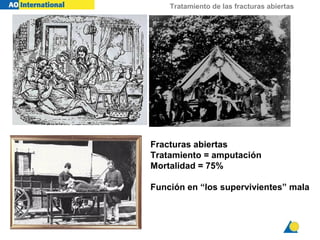 Tratamiento de las fracturas abiertas
Fracturas abiertas
Tratamiento = amputación
Mortalidad = 75%
Función en “los supervivientes” mala
 