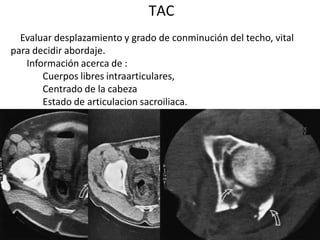 TAC
Evaluar desplazamiento y grado de conminución del techo, vital
para decidir abordaje.
Información acerca de :
Cuerpos libres intraarticulares,
Centrado de la cabeza
Estado de articulacion sacroiliaca.
 
